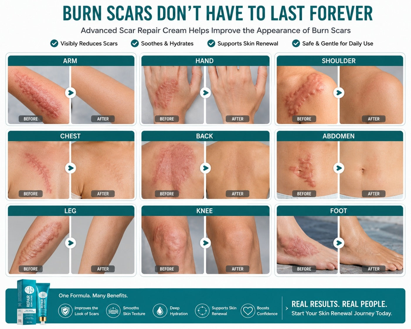 Burn scar before and after results